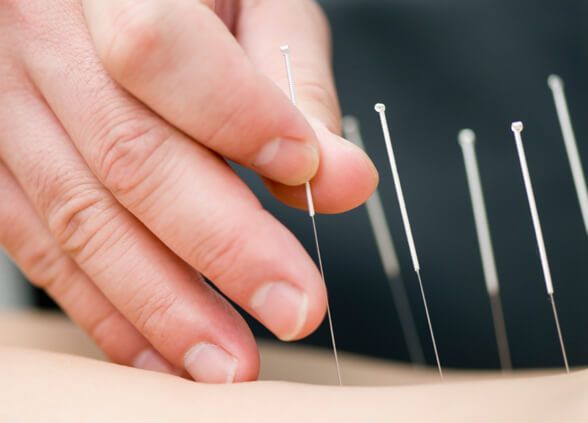 acupuncture