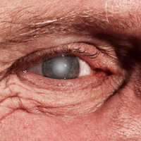 Cataracts and Alzheimer's