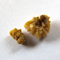 Ouch! 4 Ways to Naturally Prevent Kidney Stones