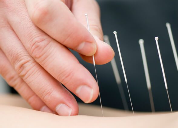 Acupuncture Therapy Promising for Parkinson's Patients