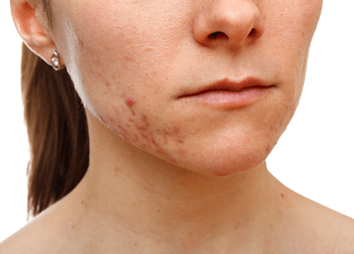 Processed Foods Giving You Skin Problems