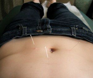 acupuncture