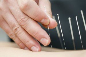 Treatment by acupuncture