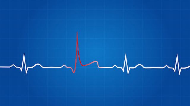 Blueprint Of Heart Attack On Electrocardiogram