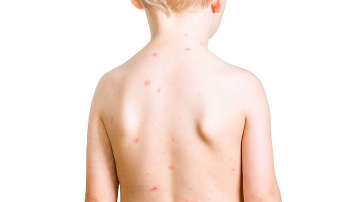 chickenpox