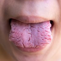 Bacterial infection disease tongue,The tongue is thrush.Tongue w