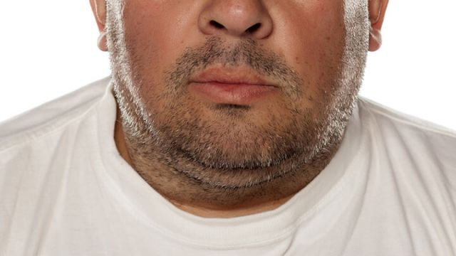double-chin