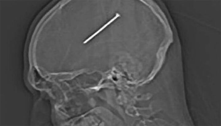 Doctors found a nail inside one man's head. (Photo Courtesy: Chicago Tribune)