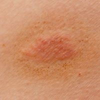 Ringworm on the skin of a person
