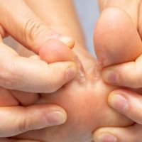 Closeup of barefoot of girl suffering with athlete’s foot due to fungal infection